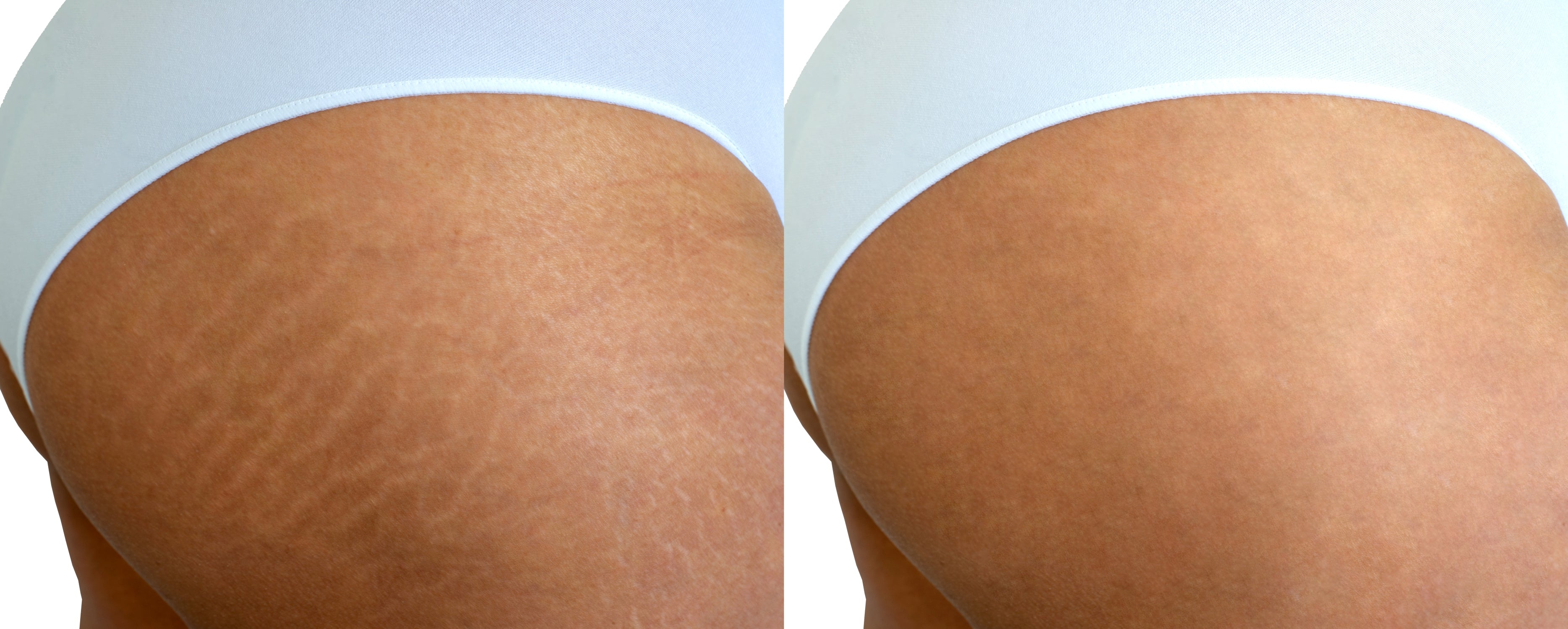 Stretchmarks Camoflauge Tattoo - 7L Micropigmentation Cartridges - 10 pieces + 3 pieces Color Correction Serum Set.