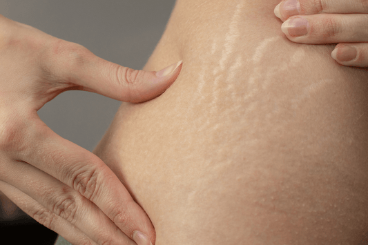 iLLUMAPRO Stretchmark Camouflage Tattoo Kit